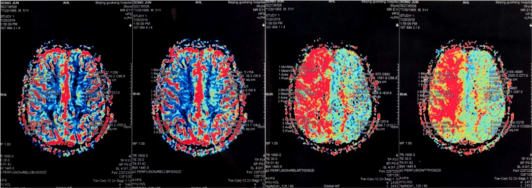 颈内动脉闭塞先进治疗,颈内动脉闭塞开通术病例讨论