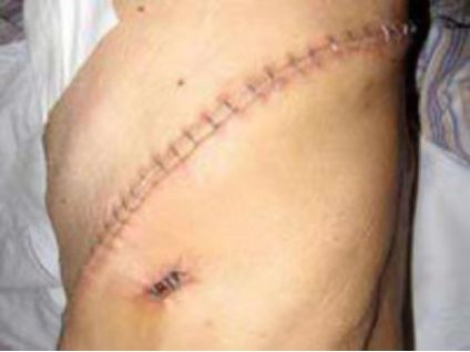 肺部肿瘤切除手术四天内出院？