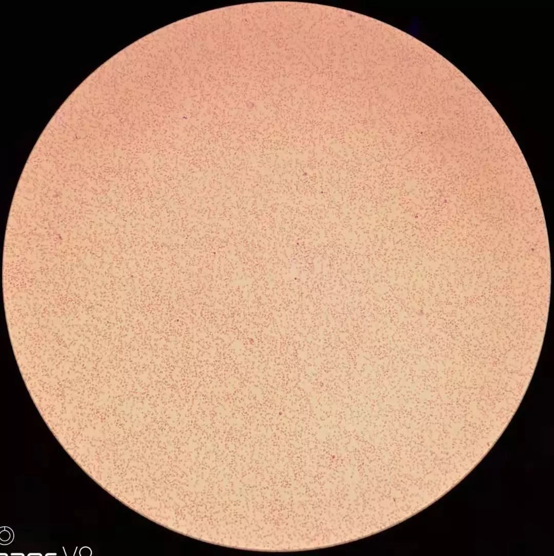 全血细胞减少就是白血病,全血细胞减少性白血病