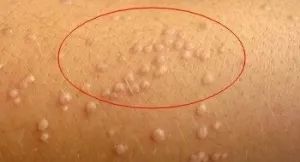 为什么脸上的痘痘那么难消,你脸上的痘痘是螨虫痘吗