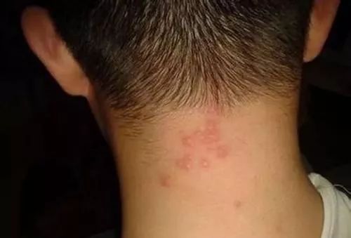 为什么脸上的痘痘那么难消,你脸上的痘痘是螨虫痘吗