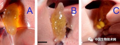 1.2大的胆结石是多长时间形成的,如何发现胆结石
