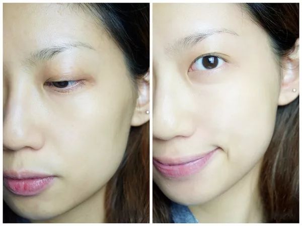 鼻头痘痘爆浆,鼻头痘痘挤出来的白色物质是什么