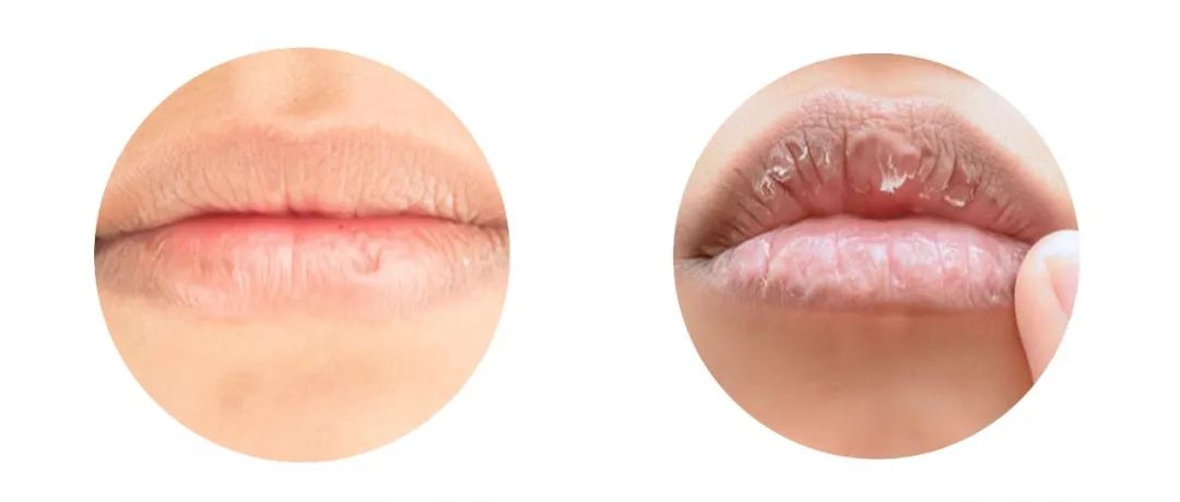 涂口红下嘴唇内侧无法上色,嘴唇像涂口红一样怎么回事