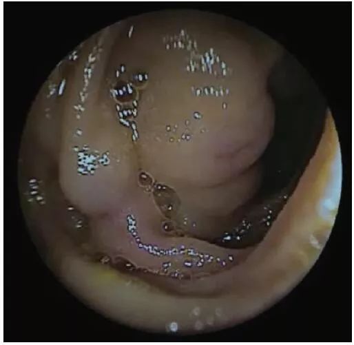「内镜新视角」小肠镜的新应用，静脉曲张出血患者的新选择