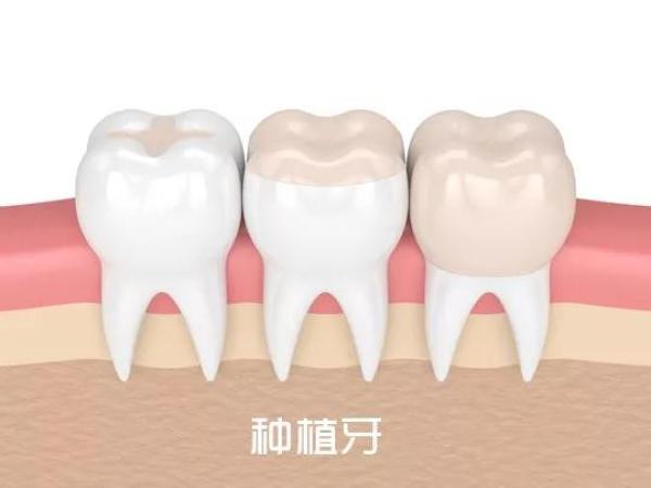 种牙钜惠丨十项费用全免！进口种植牙低至4999！大“齿”度福利来