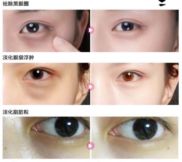 在美国治疗痔疮经历,在美国最好卖的痔疮药