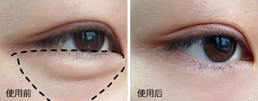 在美国治疗痔疮经历,在美国最好卖的痔疮药