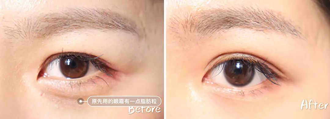 在美国治疗痔疮经历,在美国最好卖的痔疮药