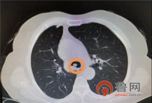 即墨一患者肿瘤堵住支气管“冷冻”技术救了她