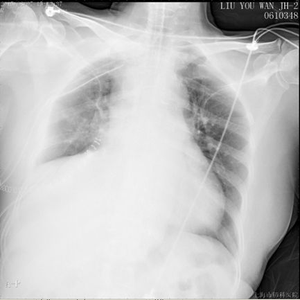 肺癌介入栓塞术后并发症,肺癌术后肺栓塞的病历模板