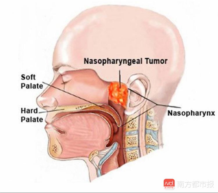 如何做好鼻咽癌放疗病人皮肤护理,鼻咽癌放疗一个疗程几天