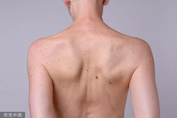 痣一边黑一边白是癌的征兆吗,痣变黑变大是癌变了还是癌前病变