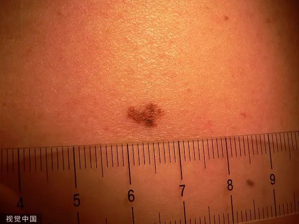 痣一边黑一边白是癌的征兆吗,痣变黑变大是癌变了还是癌前病变