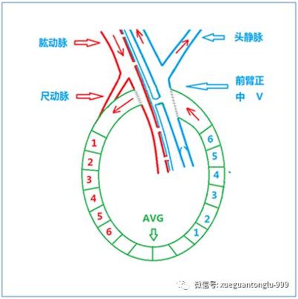 血透动静脉内瘘手术三种术式图解,血透室动静脉内瘘穿刺及护理