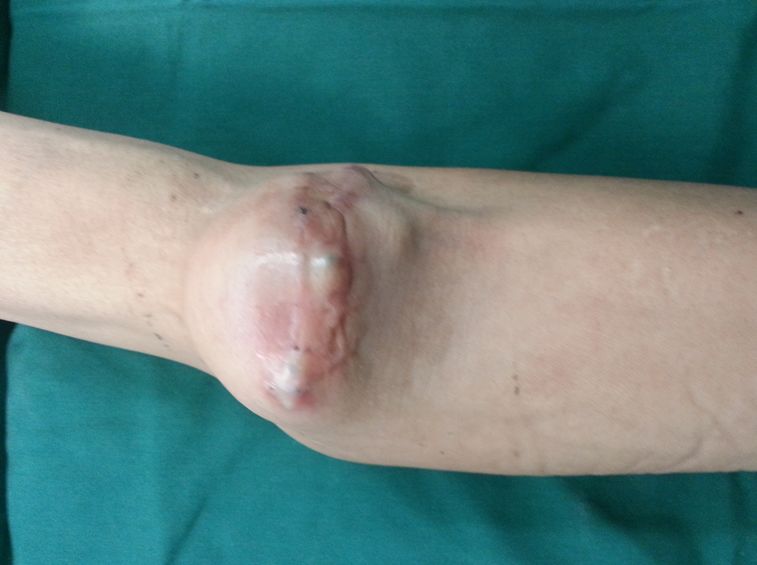 血透动静脉内瘘手术三种术式图解,血透室动静脉内瘘穿刺及护理