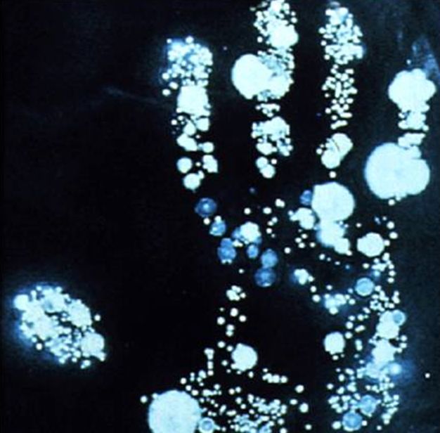 血透动静脉内瘘手术三种术式图解,血透室动静脉内瘘穿刺及护理