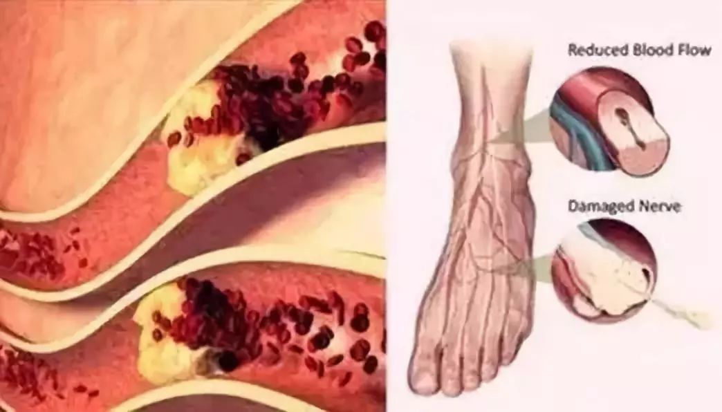 腿疼脚麻走不动可能是血管堵了,腿疼是血管不通畅造成的吗