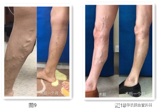 胃底静脉曲张,睾丸静脉曲张