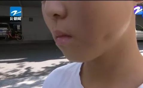 拔智齿导致面部凹陷,在医院拔智齿引发脸肿