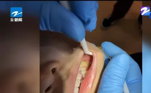 拔智齿导致面部凹陷,在医院拔智齿引发脸肿