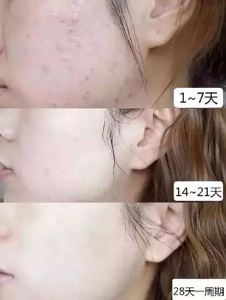 鼻头痘痘爆浆,鼻头痘痘挤出来的白色物质是什么