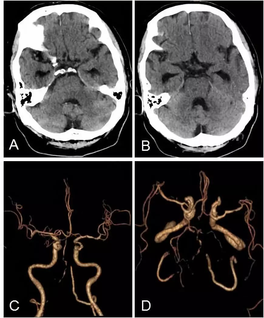 天坛周记·第147期｜右椎动脉V3-4段闭塞血管内介入治疗开通失败1例