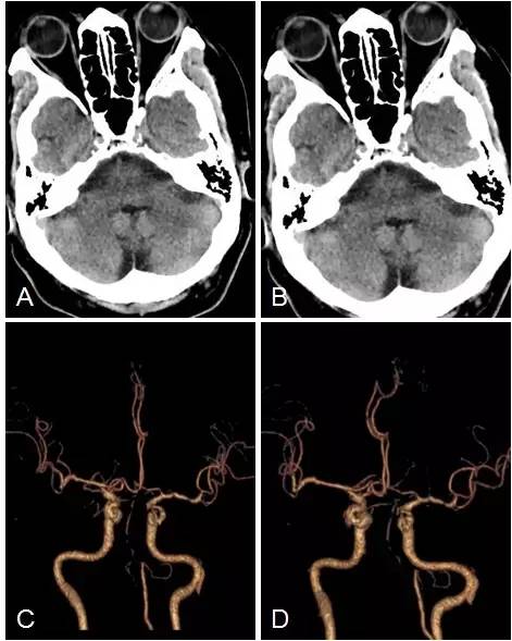 天坛周记·第147期｜右椎动脉V3-4段闭塞血管内介入治疗开通失败1例