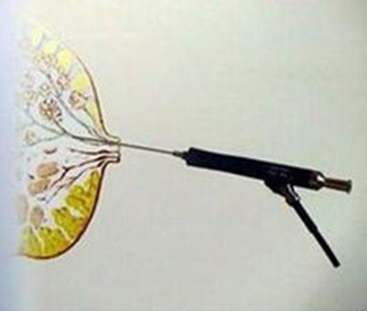 请问乳头有溢液怎么治疗,乳头溢液说明哪里不通了