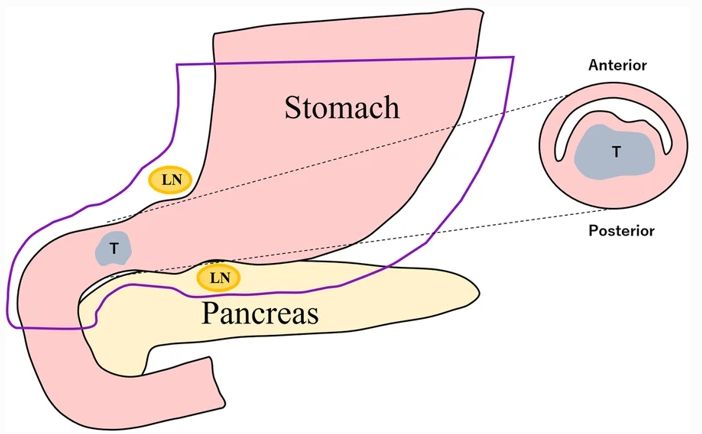 十二指肠腺癌2.5厘米几期,十二指肠癌罕见