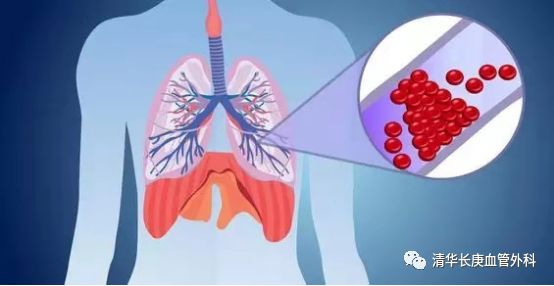 世界血栓日警惕房颤导致中风,世界血栓日的新闻报道