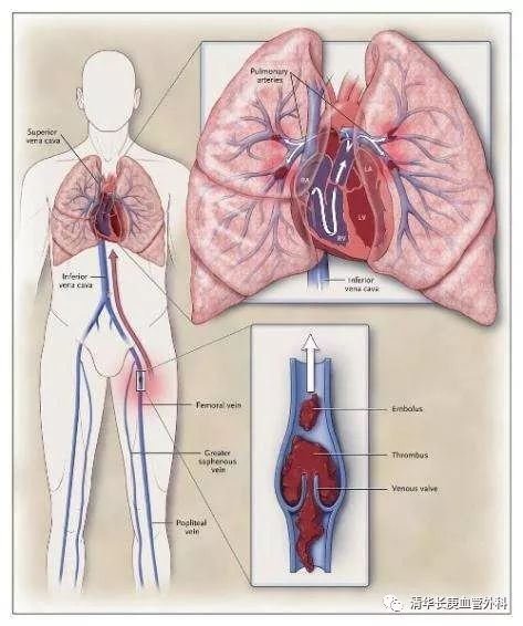 肺栓塞引起的肺动脉高压多久能好,肺栓塞缓解后肺动脉高压会缓解吗