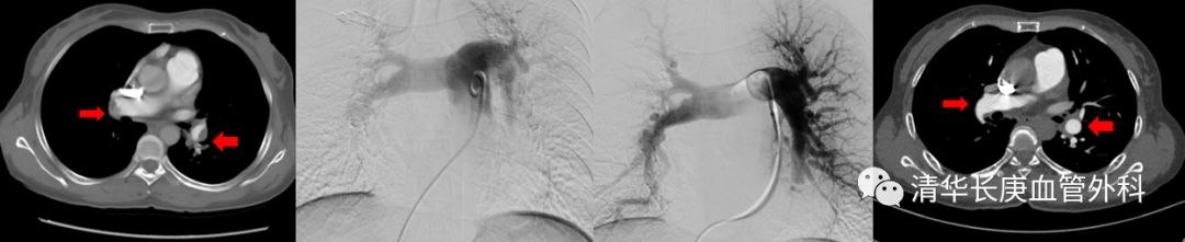 肺栓塞引起的肺动脉高压多久能好,肺栓塞缓解后肺动脉高压会缓解吗