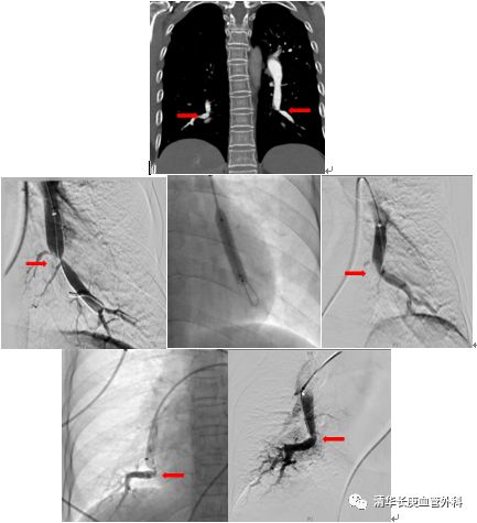 肺栓塞引起的肺动脉高压多久能好,肺栓塞缓解后肺动脉高压会缓解吗
