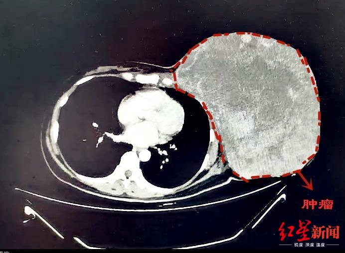 乳腺肿瘤两天疯长至西瓜大小,女子身患癌症不想治疗