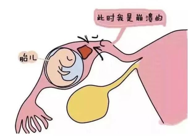 宫外孕科普粤语,宫外孕知识抖音视频