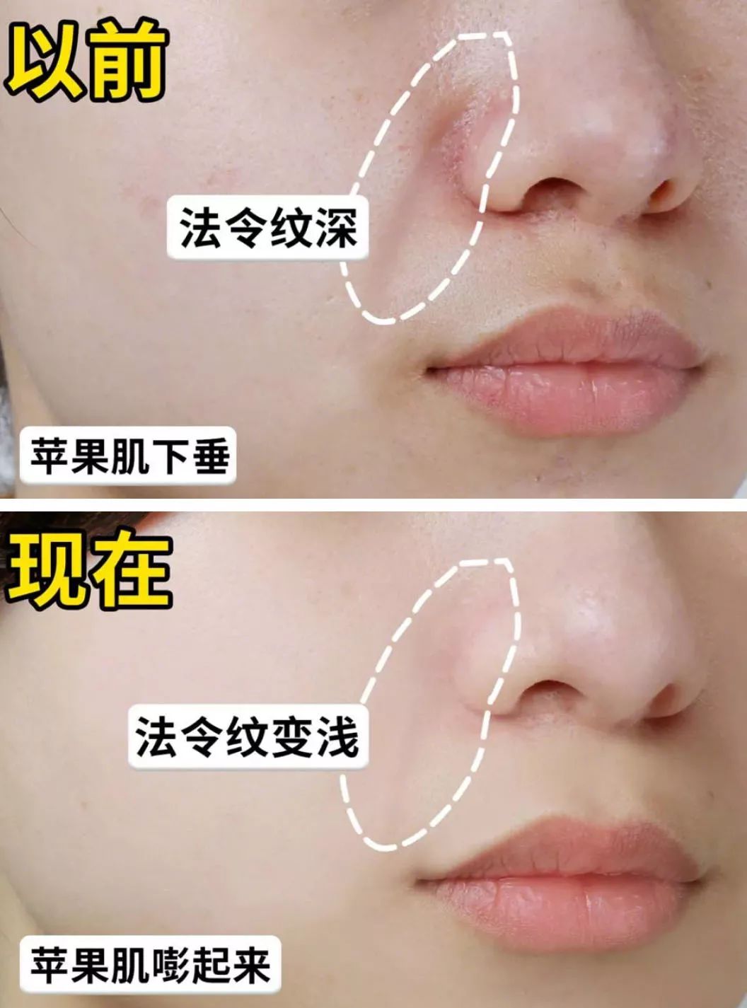 法令纹和眼纹怎么才能有效改善,法令纹贴眼贴有用吗