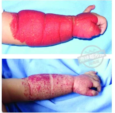 泉州家长关注！孩子身上这个“红胎记”，险些造成左眼失明