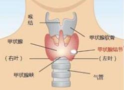 得了甲状腺结节要紧吗,得了甲状腺结节有什么感觉