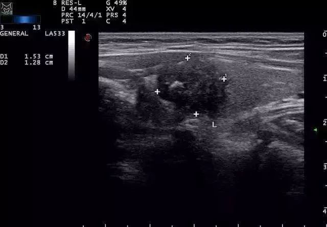 得了甲状腺结节要紧吗,得了甲状腺结节有什么感觉