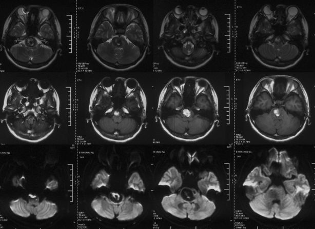穆如清风·第13期｜Tubridge治疗基底动脉巨大夹层动脉瘤