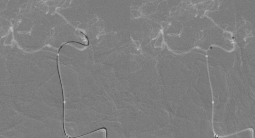 穆如清风·第13期｜Tubridge治疗基底动脉巨大夹层动脉瘤