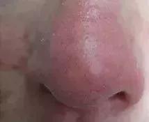 脸部去红血丝的有效方法,去红血丝的有效方法