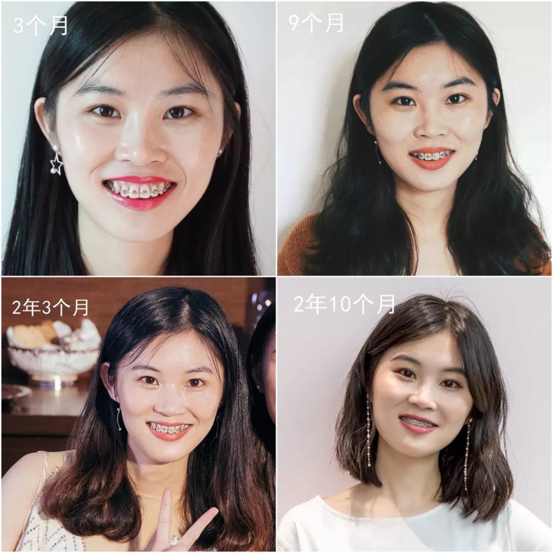戴牙套改变了脸型可以恢复吗,戴牙套改变颜值