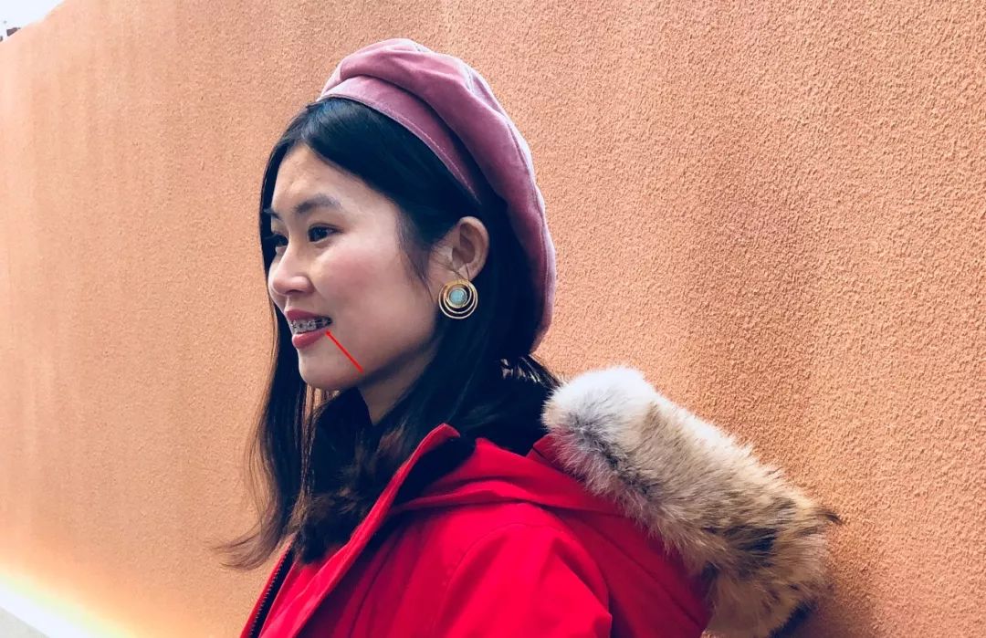 戴牙套改变了脸型可以恢复吗,戴牙套改变颜值