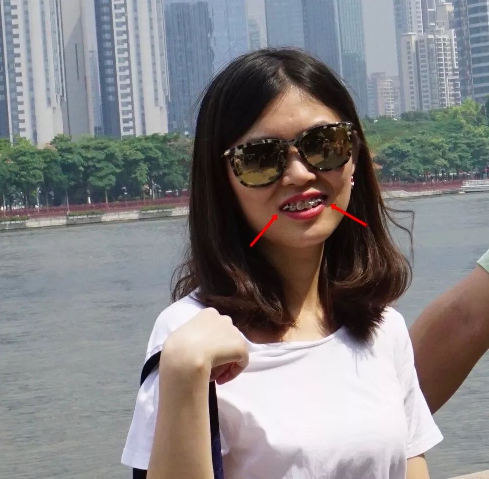 戴牙套改变了脸型可以恢复吗,戴牙套改变颜值