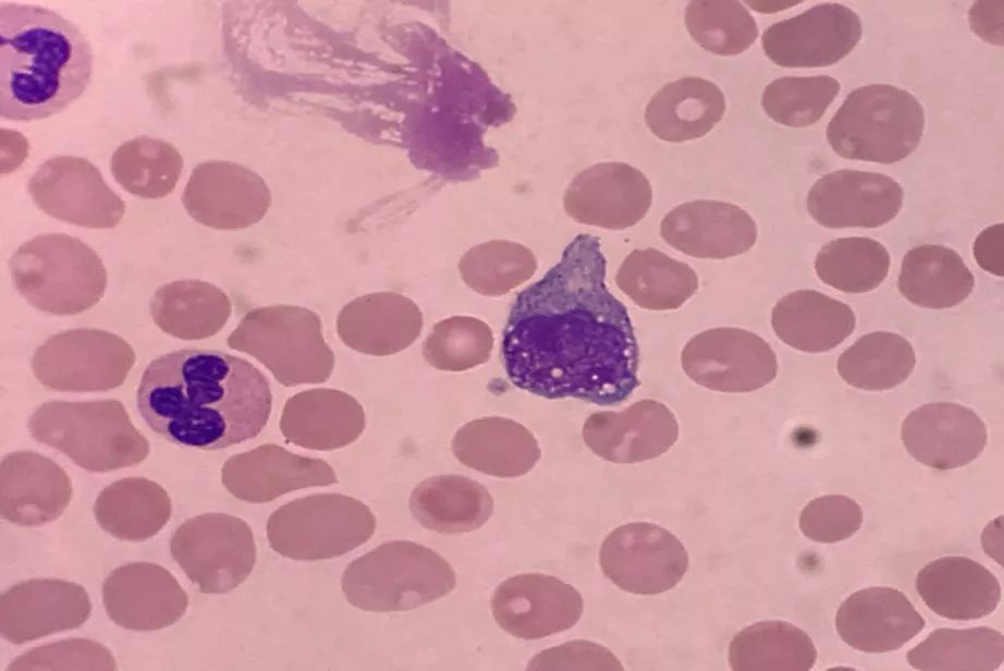 套细胞淋巴瘤胸腔侵润病例分享