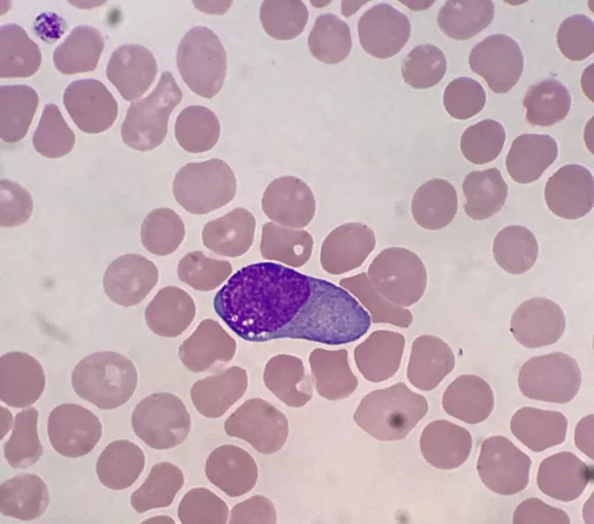 套细胞淋巴瘤胸腔侵润病例分享