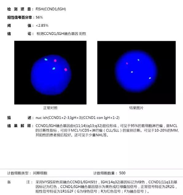 套细胞淋巴瘤胸腔侵润病例分享