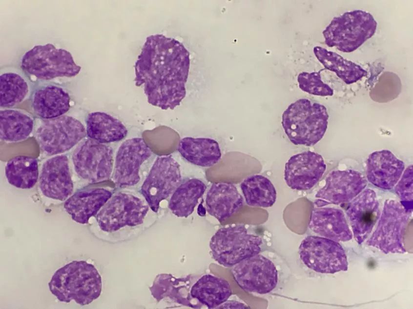 套细胞淋巴瘤胸腔侵润病例分享